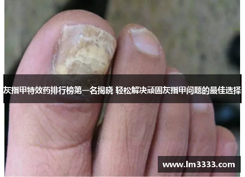 灰指甲特效药排行榜第一名揭晓 轻松解决顽固灰指甲问题的最佳选择